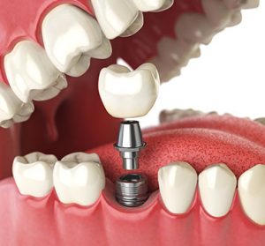 Dental Implants in Telford & Bridgnorth