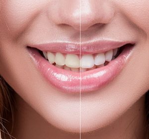 Teeth Whitening in Broseley, Telford, Bridgnorth